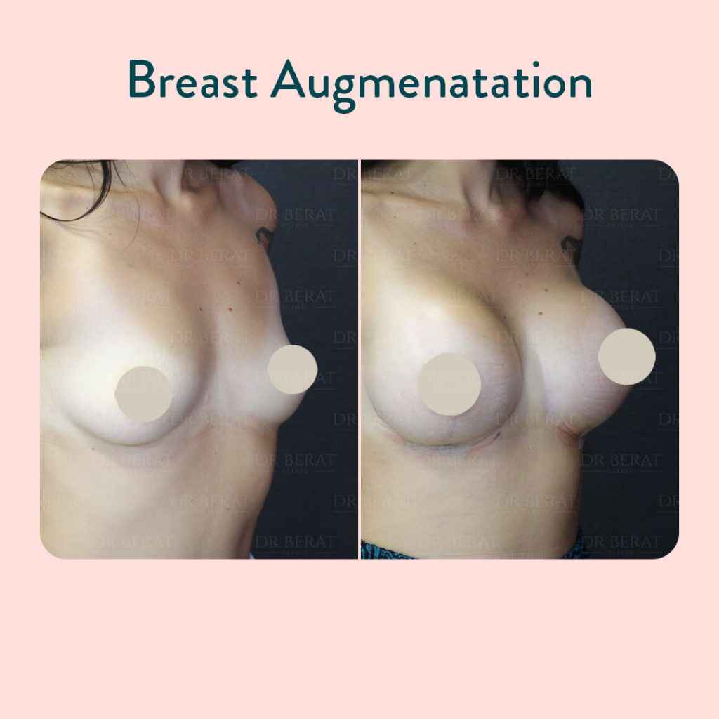 Breast Augmentation Before After Photo