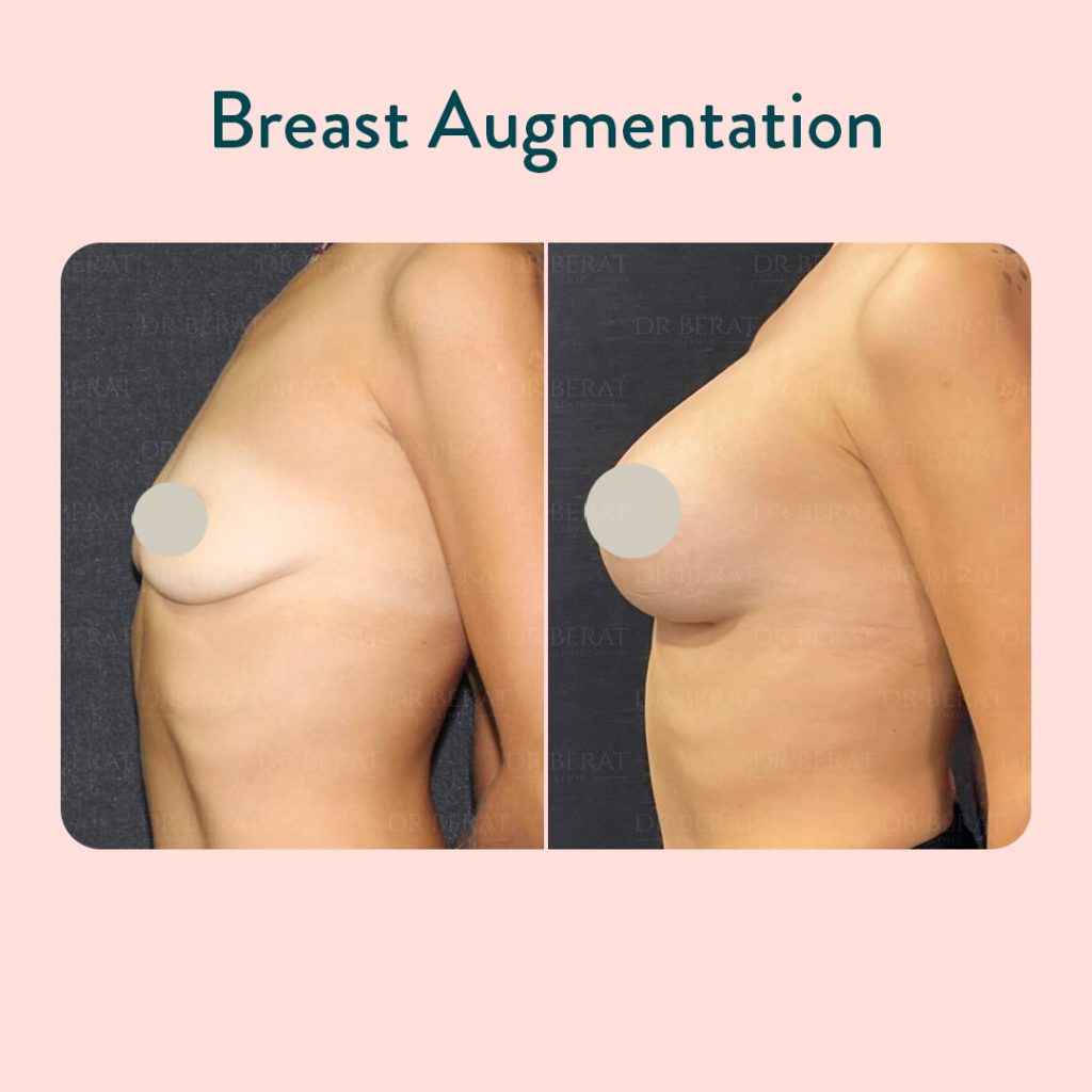 Breast Augmentation costs in Turkey
