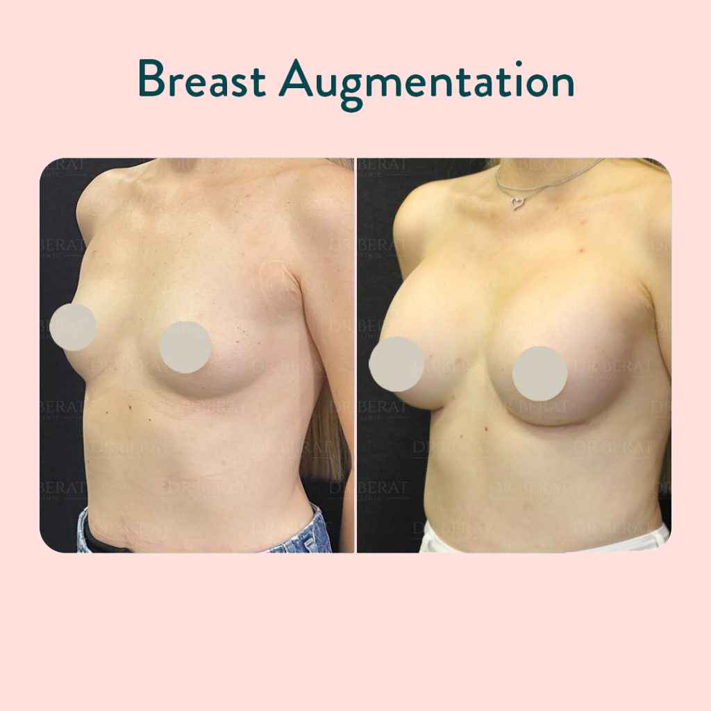 Breast Augmentation Antalya Turkey
