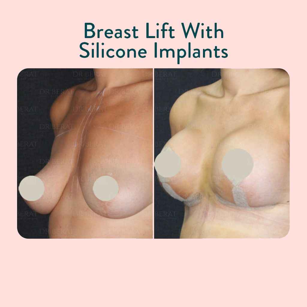Breast Lift With Silicone implant Antalya