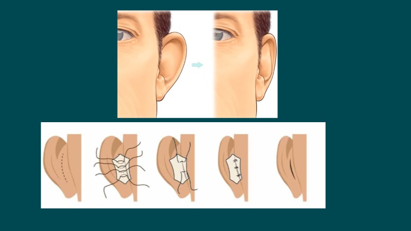 ear pinning surgery