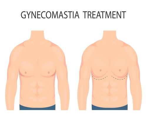 Gynecomastia-Man boobs surgery in Turkey