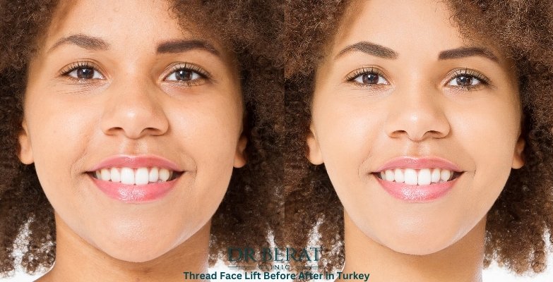 Thread Face Lift Before After in Turkey
